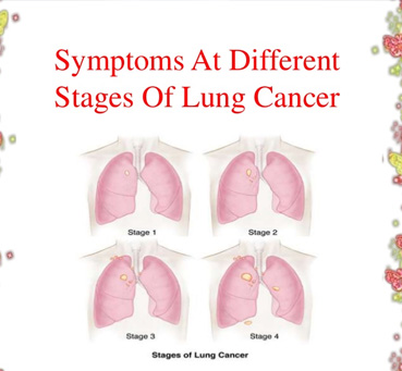 Earliest Symptoms of Lung Cancer