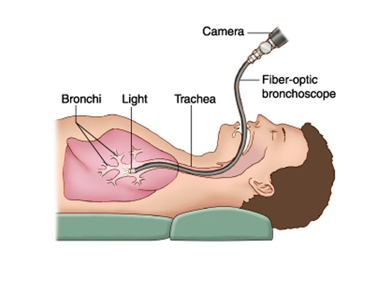 brochoscopy